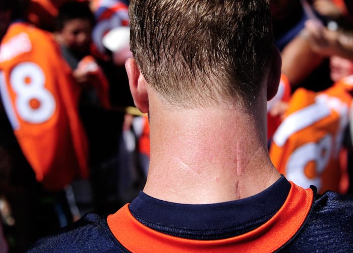 2012-Peyton-Manning-neck-scar.jpg
